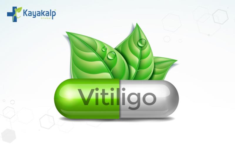 Best Vitiligo Treatment in Delhi NCR, India | Kayakalp Global